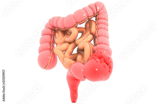 Colon cancer. Cancer attacking cell. Colon disease concept. 3d illustration