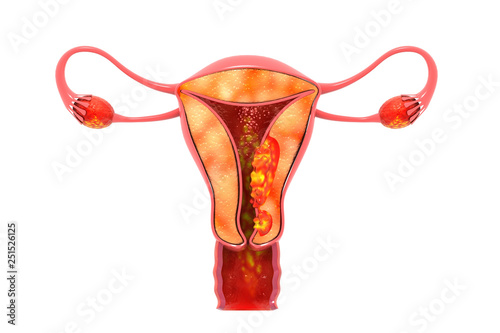 uterine cancer 3d render