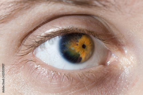 eye close up with iris dystrophy photo