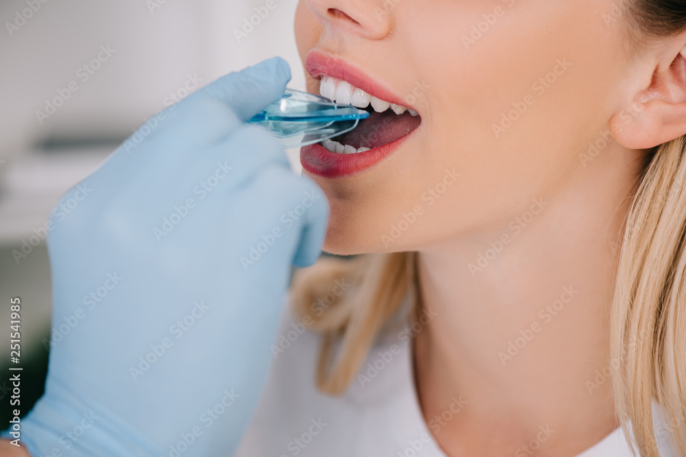 cropped view of orthodontist in latex glove putting trainer dental braces in mouth of woman during appointment in clinic cropped view of orthodontist in latex glove putting trainer dental braces in mouth of woman during appointment in clinic