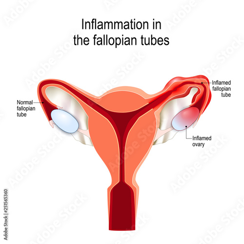 fallopian tubes Inflammation photo