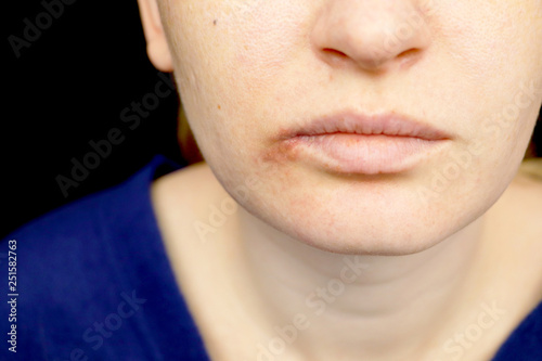 Herpes on the lips: a woman with a cold and the herpes virus is examined by a dermatologist and infectious disease specialist