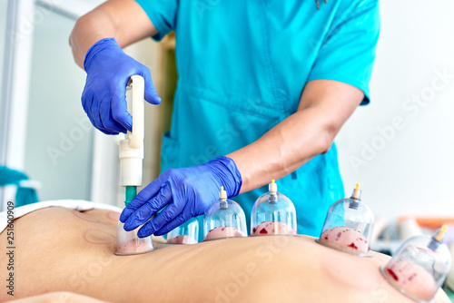 Healing bloodletting, hijama or phlebotomy. Hajam master conducts cupping therapy on a young woman. Islamic medicine photo