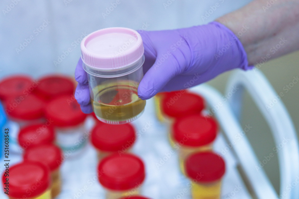 Urine samples in special tubes for examination. On the background of tubes with blood samples in the clinical laboratory Urine samples in special tubes for examination. On the background of tubes with blood samples in the clinical laboratory