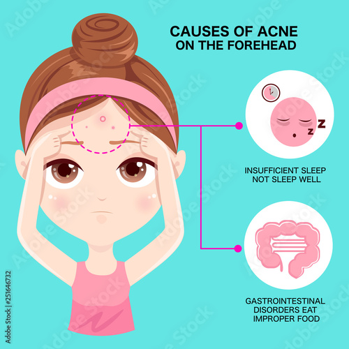 Causes of acne on the forehead