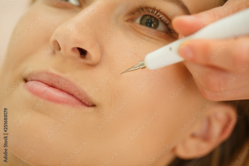 Closeup of process of blackheads removing in cosmetology salon. Young lady smiling and lying while  doctor doing procedure of face cleaning. Concept of cleansing, beauty and skin care.