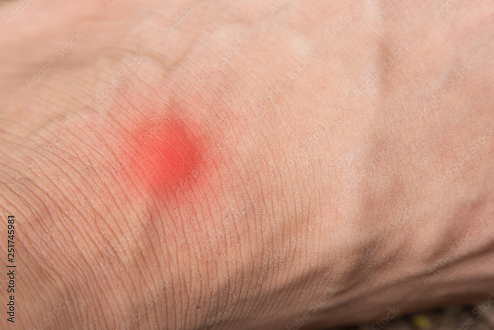 Fototapeta premium red hurt wound on human skin 