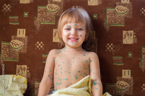 The child having chicken pox sits in a bed and joyfully smiles. A look in the camera photo