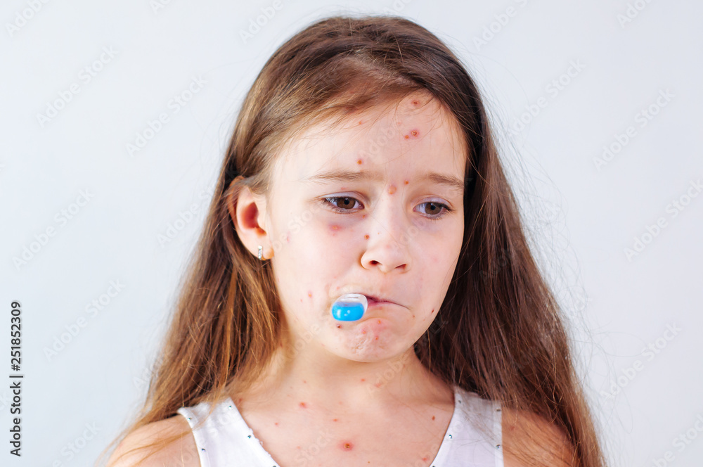 Closeup of cute sad little girl. Varicella virus or Chickenpox bubble rash on child Closeup of cute sad little girl. Varicella virus or Chickenpox bubble rash on child