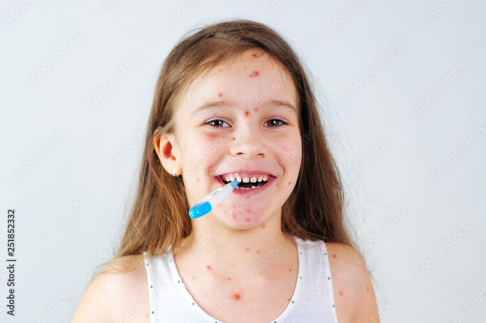 Closeup of cute funny little girl. Varicella virus or Chickenpox bubble rash on child Closeup of cute funny little girl. Varicella virus or Chickenpox bubble rash on child