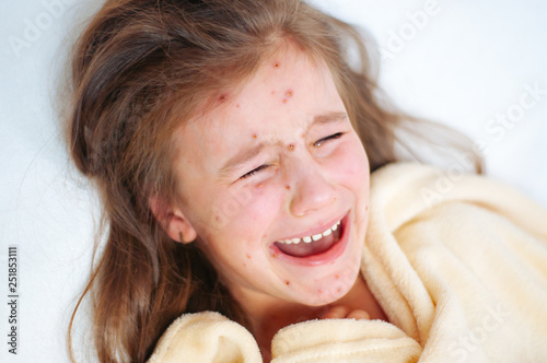 Closeup of cute sad crying little girl in bed. Varicella virus or Chickenpox bubble rash on child