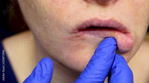 Herpes on the lips: a woman with a cold and the herpes virus is examined by a dermatologist and infectious disease specialist photo