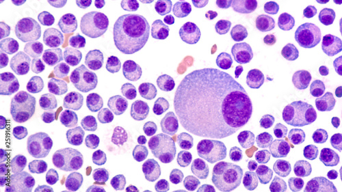Multiple Myeloma Awareness: Bone marrow aspirate cytology of multiple myeloma, a type of bone marrow cancer of malignant plasma cells, associated with bone pain, bone  fractures and anemia. photo