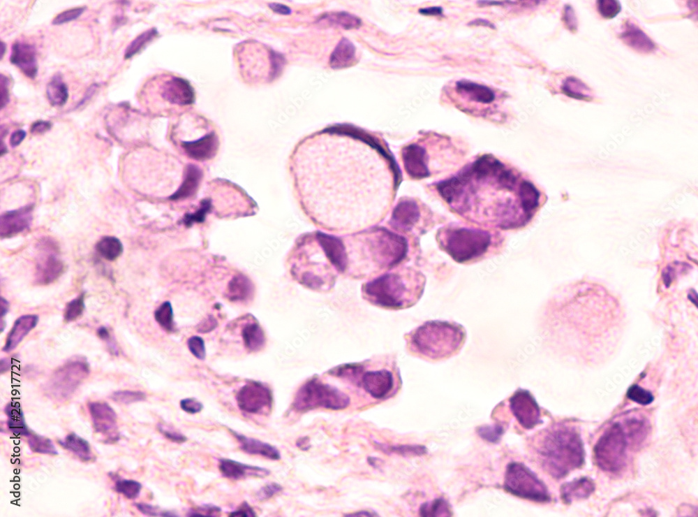 An Unusual Case of Carcinoma Erysipelatoides Originating from Gastric  Adenocarcinoma