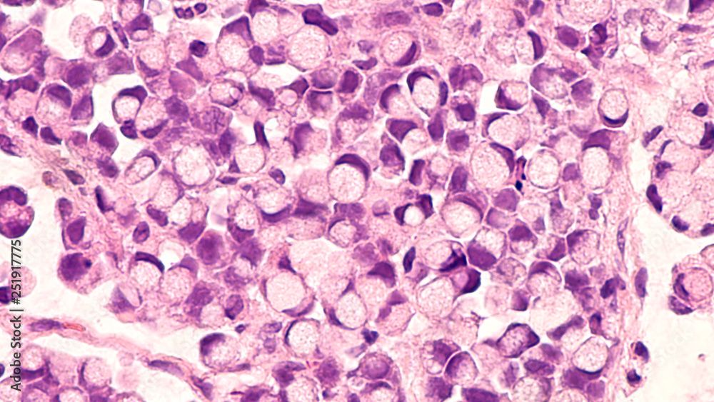 Microscopic image (photomicrograph) of a poorly differentiated gastric  mucinous adenocarcinoma (stomach cancer), signet ring cell type. Tumor  cells have appearance of a traditional signet ring. Stock Photo | Adobe  Stock