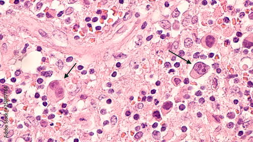 Microscopic image of a lymph node in a patient with Hodgkin's Disease (lymphoma), showing two Reed Sternberg cells in the same field. photo