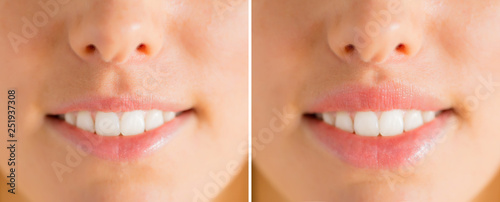 Woman's lips before and after filler injections