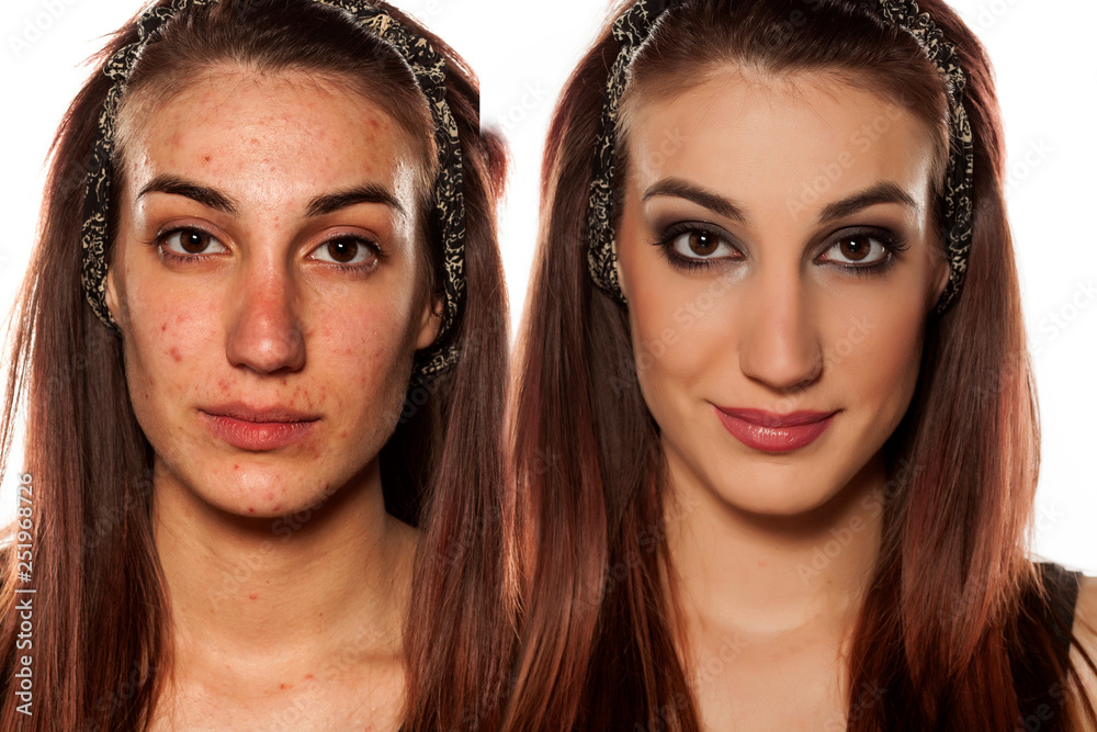 Comparision portrait of woman with problematic skin, before and after makeup  and editing Stock Photo | Adobe Stock