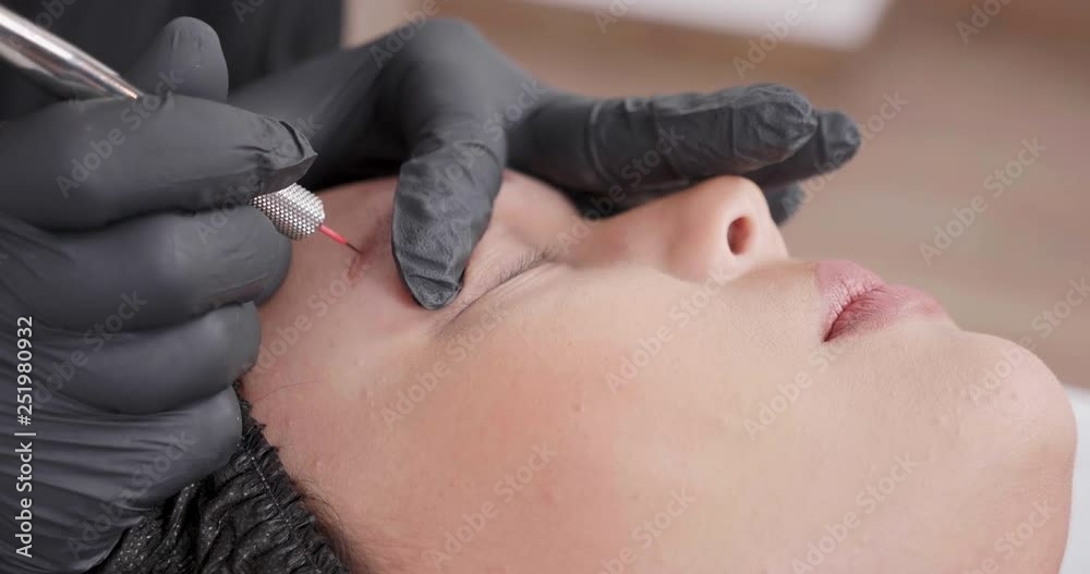 Close up of a eyebrow tattoo removal technique performed by a beautician. Staccato motion of hand pulling the ink up to the surface of epidermis. Close up of a eyebrow tattoo removal technique performed by a beautician. Staccato motion of hand pulling the ink up to the surface of epidermis.