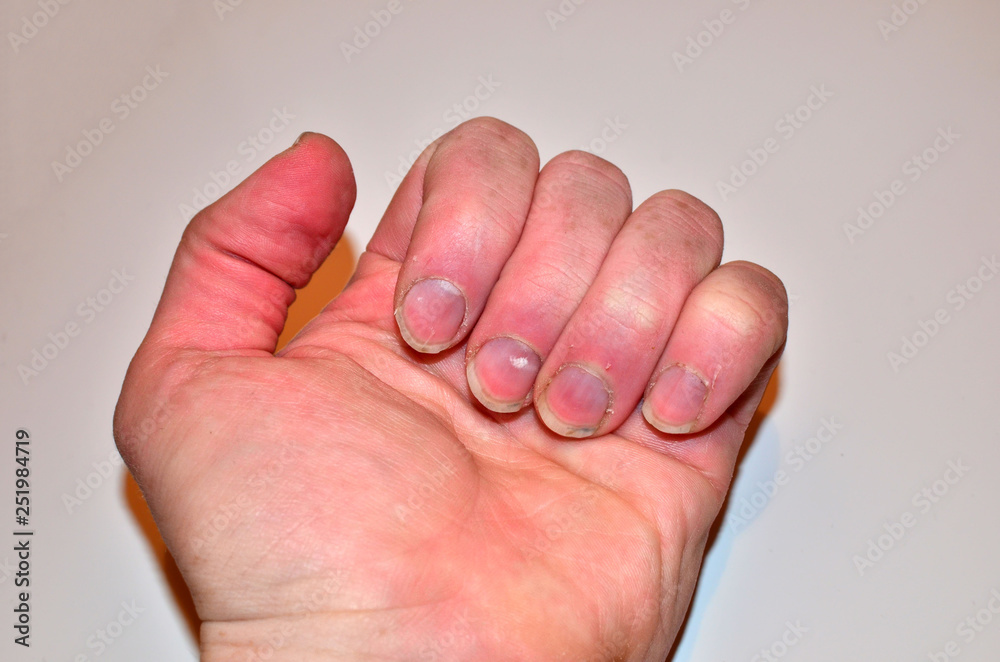 Male nails disease, fingernail lack of nutrients and do not make nail not  shape and not care, health care concept Stock Photo | Adobe Stock
