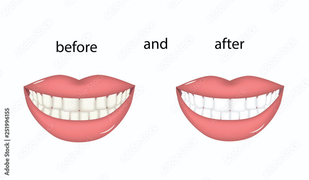 Fototapeta premium Whitening - Female teeth before and after - isolated on white background - flat style - vector