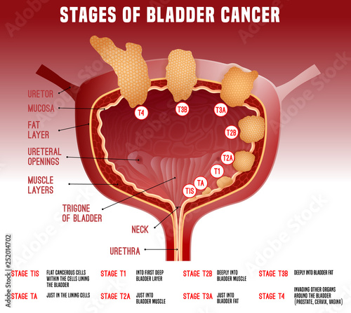 Bladder Cancer Image