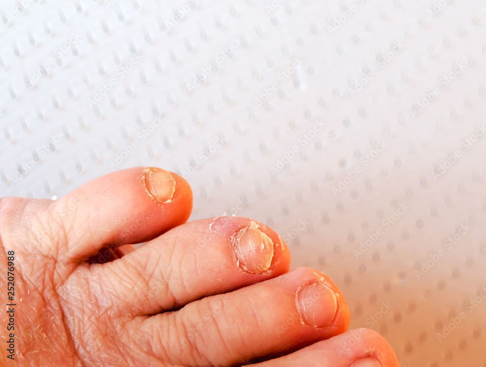 Foot foot. Disease of the skin. Fungal infection. Stock Photo Adobe Stock