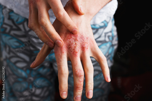 Man scratch oneself, dry flaky skin on hand with psoriasis vulgaris, eczema and other skin conditions like fungus, plaque, rash and patches. Autoimmune genetic disease. photo