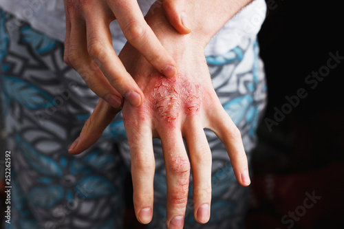 Man scratch oneself, dry flaky skin on hand with psoriasis vulgaris, eczema and other skin conditions like fungus, plaque, rash and patches. Autoimmune genetic disease.