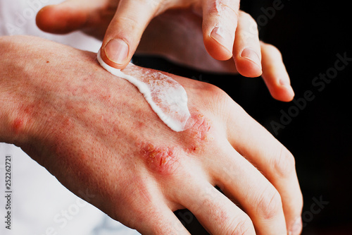 Eczema on the hands. The man applying the ointment , creams in the treatment of eczema, psoriasis and other skin diseases. Skin problem concept photo