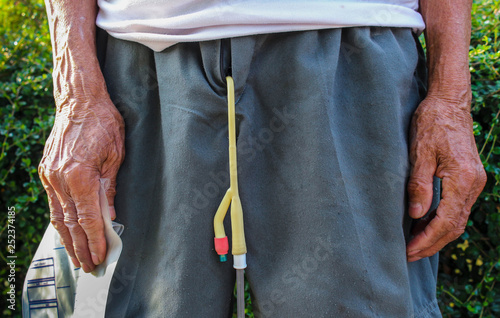 An elderly Asian man suffering from pain in the urinary system Diseases for men. Enlarged prostate.Urinary catheter.