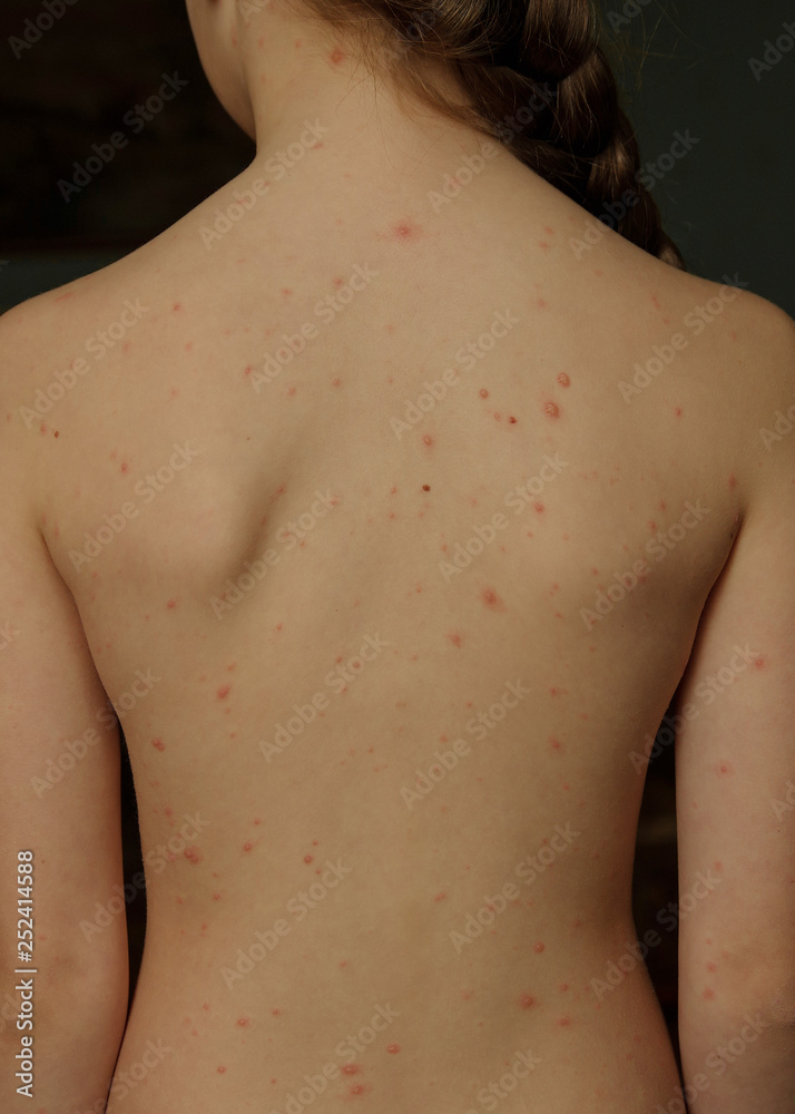 Close-up of naked body of child with pimples of chicken pox. pimples on the body of child with chickenpox Close-up of naked body of child with pimples of chicken pox. pimples on the body of child with chickenpox