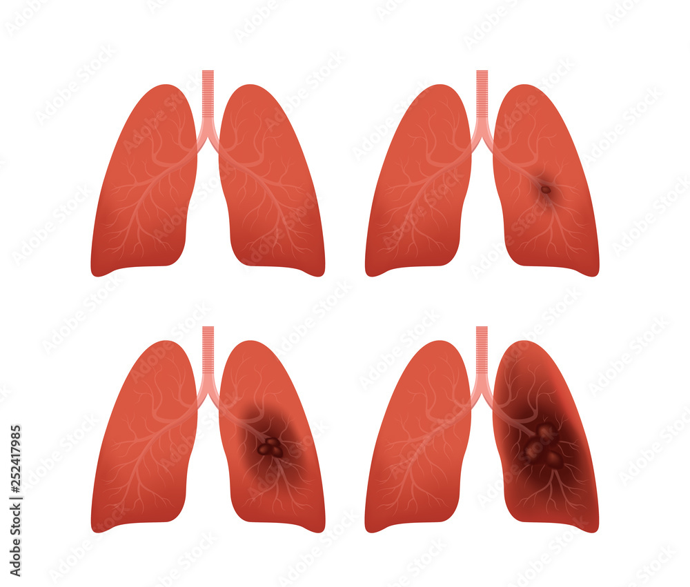 lung cancer stages vector / tumor Stock Vector | Adobe Stock