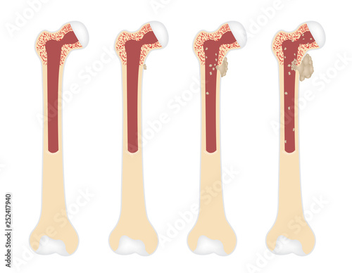 bone cancer vector stages / tumor