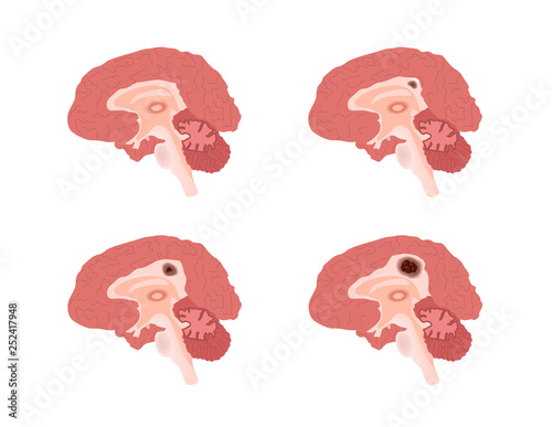 brain cancer vector stages / tumor