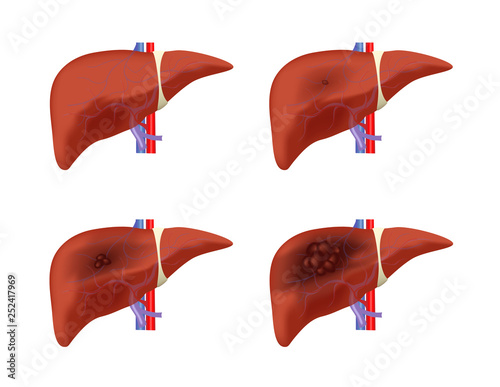 liver cancer stages vector / tumor