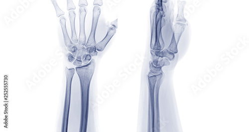 X-ray image of left wrist joint Ap and Lateral view. rheumatoid arthritis concept.