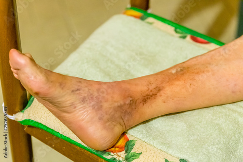 Foot of elderly woman with phlebitis