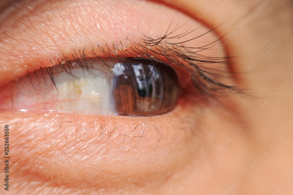 Obraz premium close up Blepharitis or Eyelid inflammation healthy eyes concept