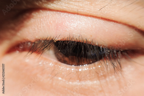 Bild auf Leinwand close up Blepharitis or Eyelid inflammation eyes healthy concept