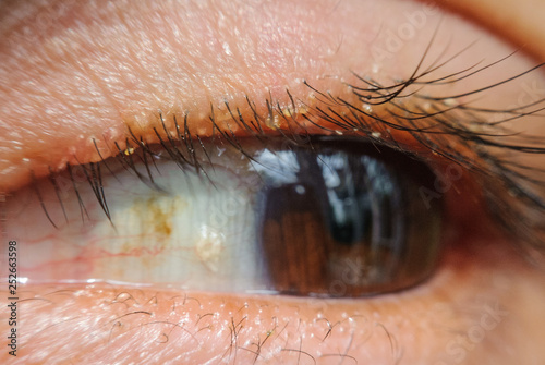 close up Blepharitis or Eyelid inflammation eyes healthy concept