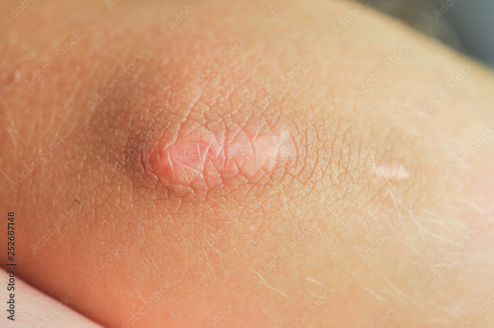 Scar on the skin. Scar on the skin.