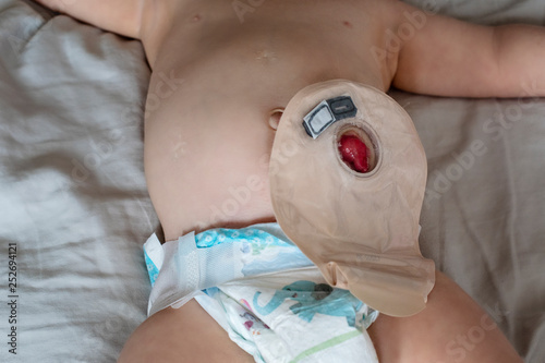 Close-up top view on transparent colostomy pouch attached to baby patient. Ostomy bag with filter. Colostomy surgery. photo