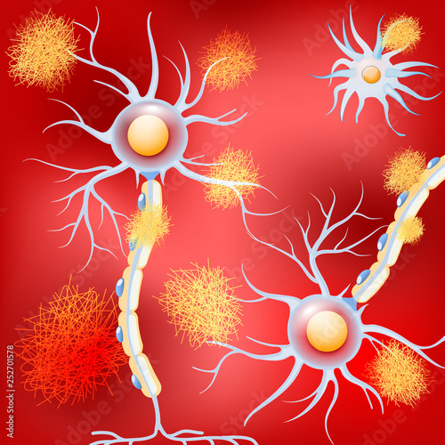 Neurons in the brain with Alzheimer's disease, and amyloid plaques.