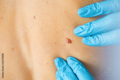 Dermatologist examine birthmark on patient's skin © Kaspars Grinvalds