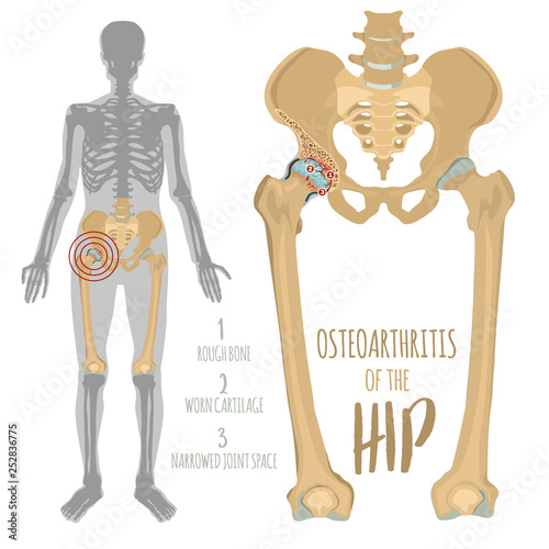 Hip Osteoarthritis Image