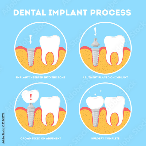 Dental implant process. Medical treatment and dentistry.