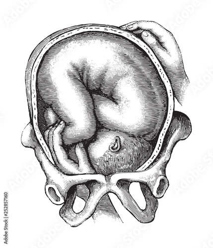 Childbirth / vintage illustration from Die Frau als hausarztin 1911