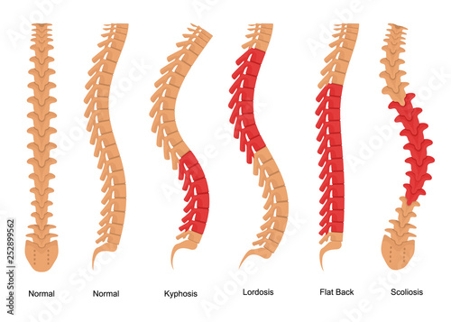 Osteoporosis Bone Types Infographics Concept Card Poster. Vector photo