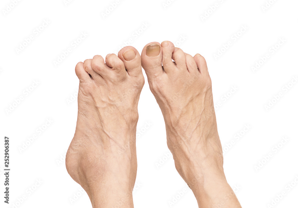 Rheumatoid arthritis in the feet. - obrazy, fototapety, plakaty 